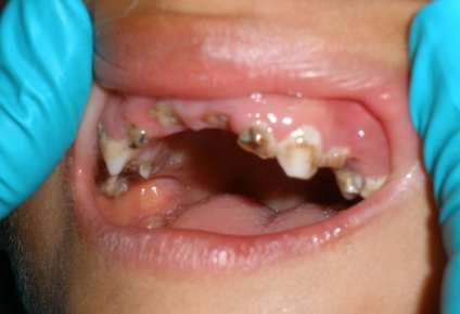 Creșterea pe gingie după extracția dinților - fotografie și descriere
