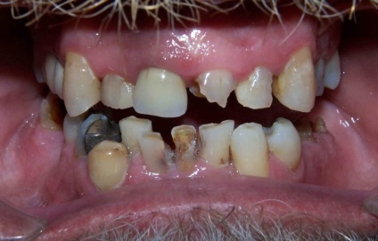 Creșterea pe gingii după extracția dinților - fotografie și descriere