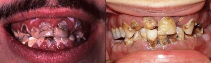 Creșterea pe gingie după extracția dinților - fotografie și descriere