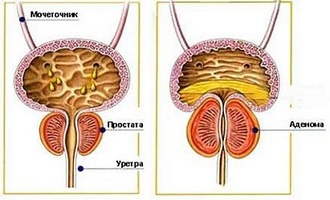 Secretele de tratament a prostatitei cu sifon se găsesc