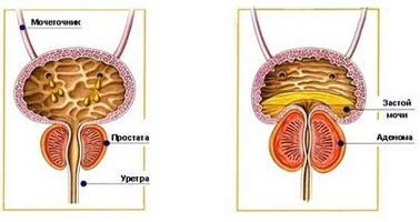 Secretele de tratament a prostatitei cu sifon se găsesc