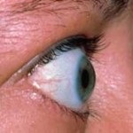 Nystagmus este posibil să se elimine patologia aparatului oculomotor