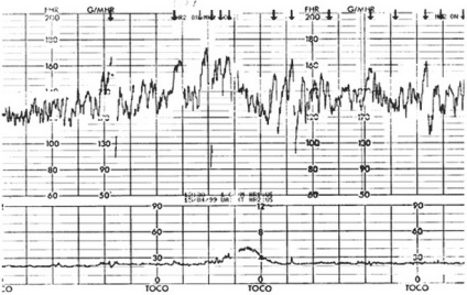 Rata variabilității și tratamentului cardiac fetal