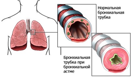 Légzési elégtelenség a bronchiális asztmás karakterrel, kezelés