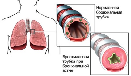 Диспнеята в бронхиална астма характер, лечението