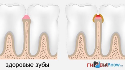 Despre gingivită în timpul sarcinii