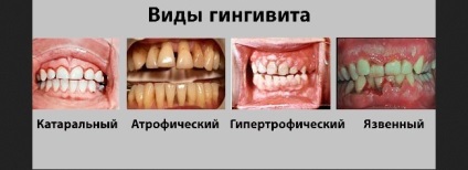 Despre gingivită în timpul sarcinii