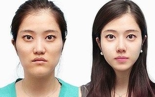 Működés az arcvonások csökkentése érdekében, a fotó eredményei előtte és utána, a portál esztétikája