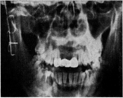 Erori și complicații în timpul tratamentului în spitalizare - fracturi maxilare