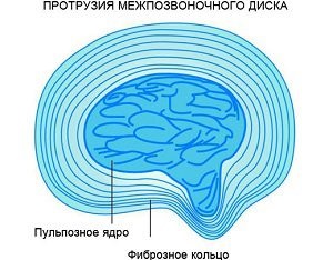 Caracteristicile blocajului cu proeminența discului intervertebral