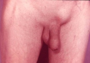 Hernia inghinala la barbati - simptome, diagnostic, tratament
