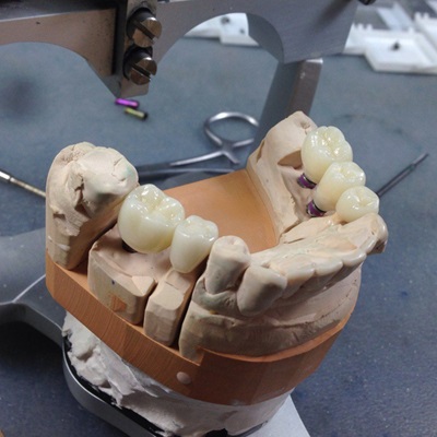 Coroane de plastic pe dinți (coroane de plastic) etapele de fabricație, prețuri, indicații pentru instalare