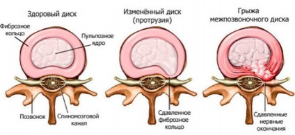 Osteocondroza post-traumatică