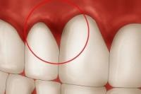 Cauzele recesiunii gingiilor și cum să o oprești