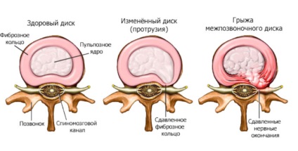 Protruzia coloanei vertebrale a coloanei vertebrale lombare cum să se vindece, cele mai bune metode