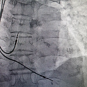 Unitatea de angiografie cu raze X siemens artis zee