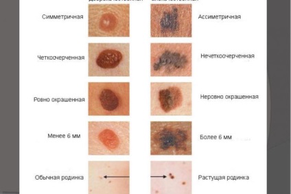 Moles, descrierea tratamentului simptomelor