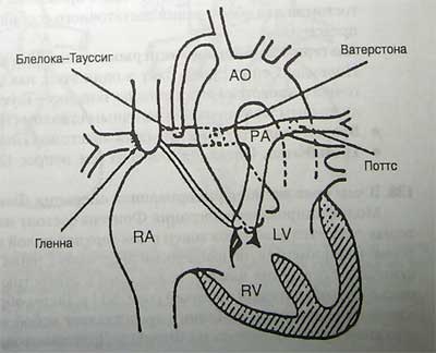 Shunt chirurgie pentru defecte cardiace la nou-nascuti - site-ul ambulanta neoficiale