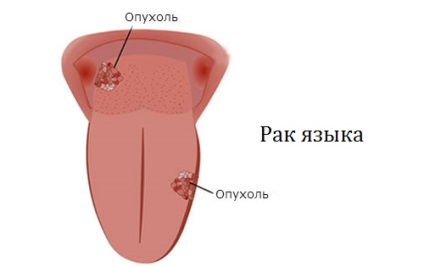 Simptomele cancerului limbii și principalele metode de tratare a bolii