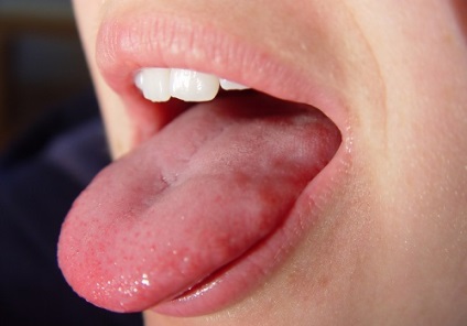 Simptomele cancerului limbii și principalele metode de tratare a bolii