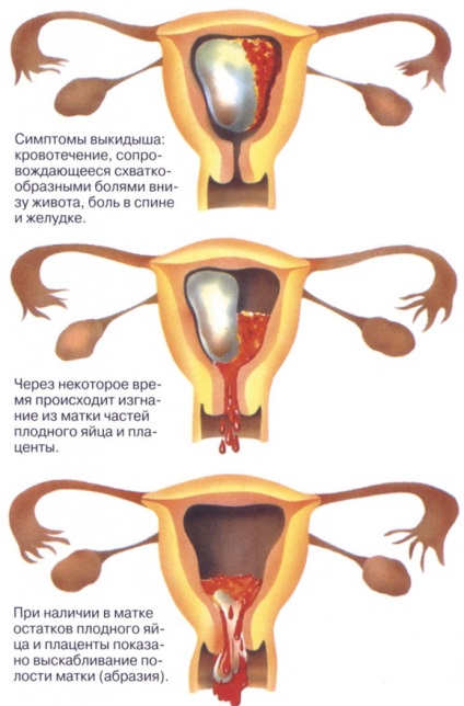 Simptomele avortului spontan în primele etape