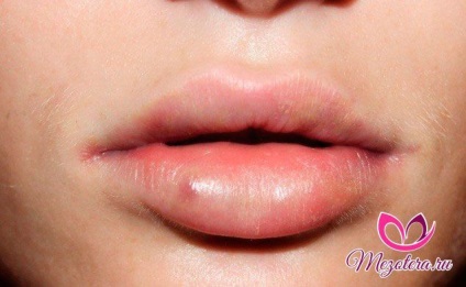 Umflarea după provocările de augmentare a buzelor de acid hialuronic și remedii