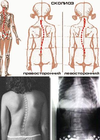 Scolioza gradului 2, simptome, tratament și fotografii
