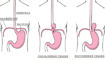 Csúszó hernia - nyelőcső, inguinális, hiatal, axiális, gyomor, kezelés, fotó