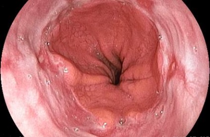 Relația dintre esofagita de reflux și bulbită