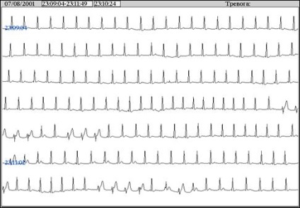 Tele-ecg monitorizare telemetrică eq în timp real, platformă de conținut