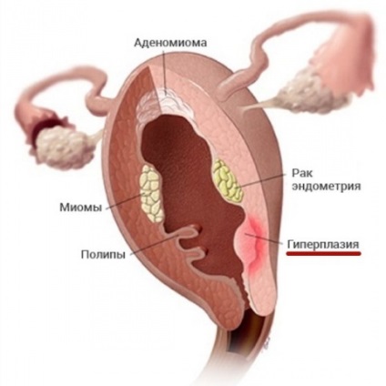 Grosimea endometrului cu hiperplazie