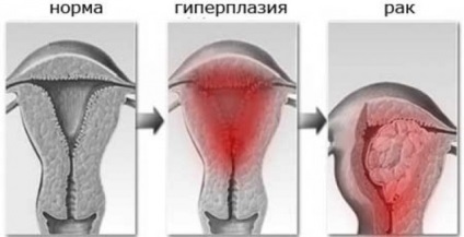 Grosimea endometrului cu hiperplazie