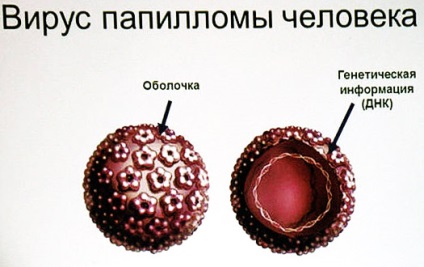 Eliminarea reviziilor cu laser de papilomavirus, contraindicații, efecte, prețuri