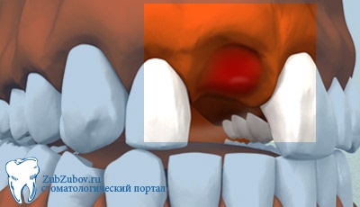 Înțelegerea dinților, complicații și consecințe sub formă de edem, temperatură și hemoragie a rănii