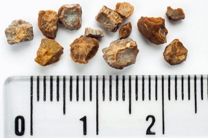 Tipuri de pietre la rinichi clasificarea concrementelor, tratament