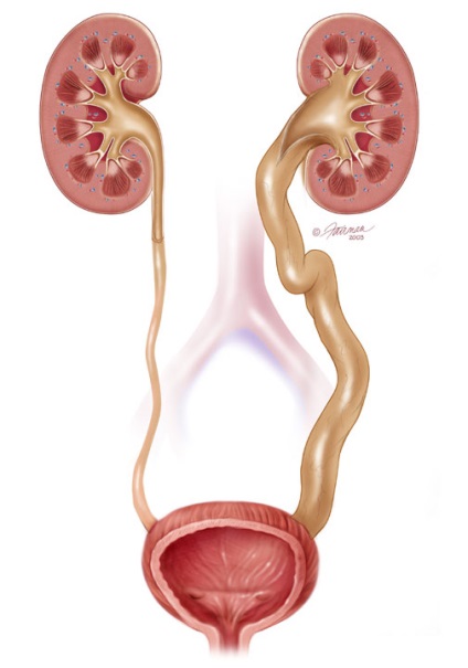 Inflamația simptomelor și tratamentul ureterului