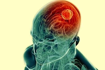 Cauzele inflamării cerebrale, simptome, metode de tratament