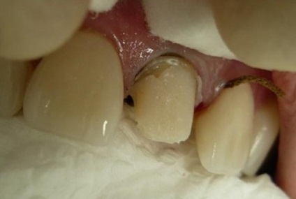 Refacerea ciocanului unui dinte care fixează o coroană nemetalică