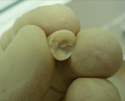 Refacerea ciocanului unui dinte care fixează o coroană nemetalică