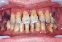 De ce aveți nevoie de tratament ortodontic