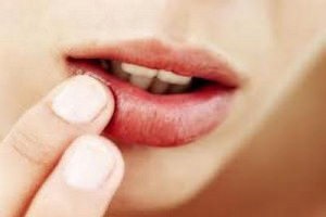 Zaeda a száj sarkában - a repedések okai, hogyan kell kezelni a cikkeket