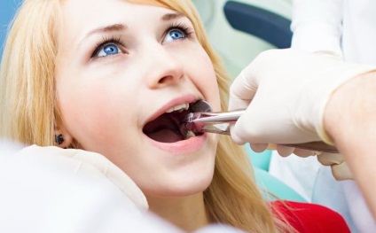 Száj a fogak kitermelési okait és megelőzését követően