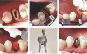 Dentară inserție dentară pentru coroană în stomatologie, prețuri, fotografie