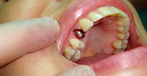 Fogfogorvos fogkrém a korona fogászat, árak, fotó