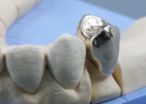 Dentară inserție dentară pentru coroană în stomatologie, prețuri, fotografie