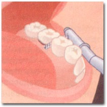 Proteză dentară