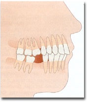 Proteză dentară