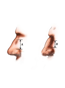 Anatomia pliurilor nazolabiale - blogul proiectului omorfia