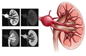 Anevrismul arterei renale, ce este și modul în care este tratată