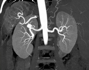 Anevrismul arterei renale, ce este și modul în care este tratată